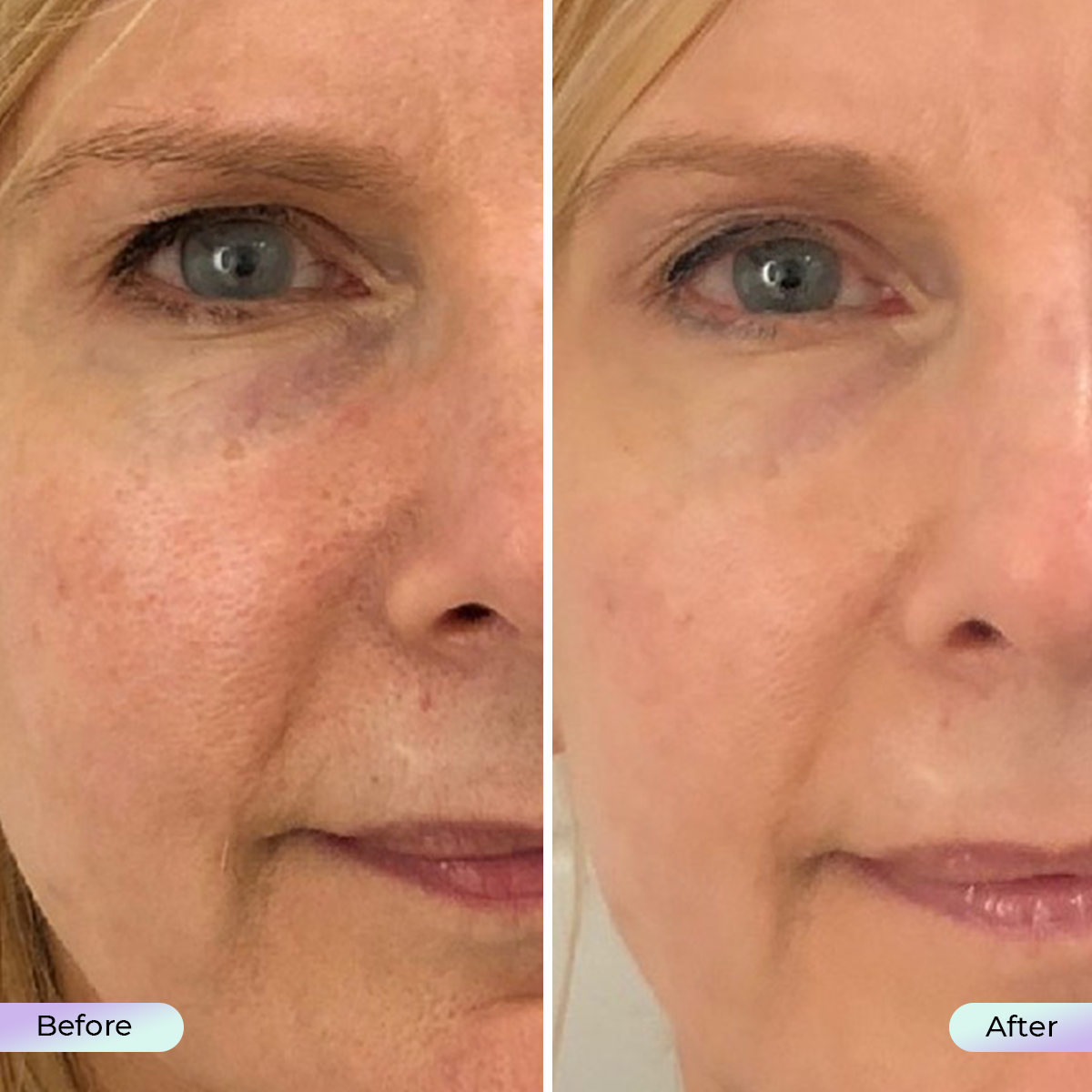 Aduro Facial Mask