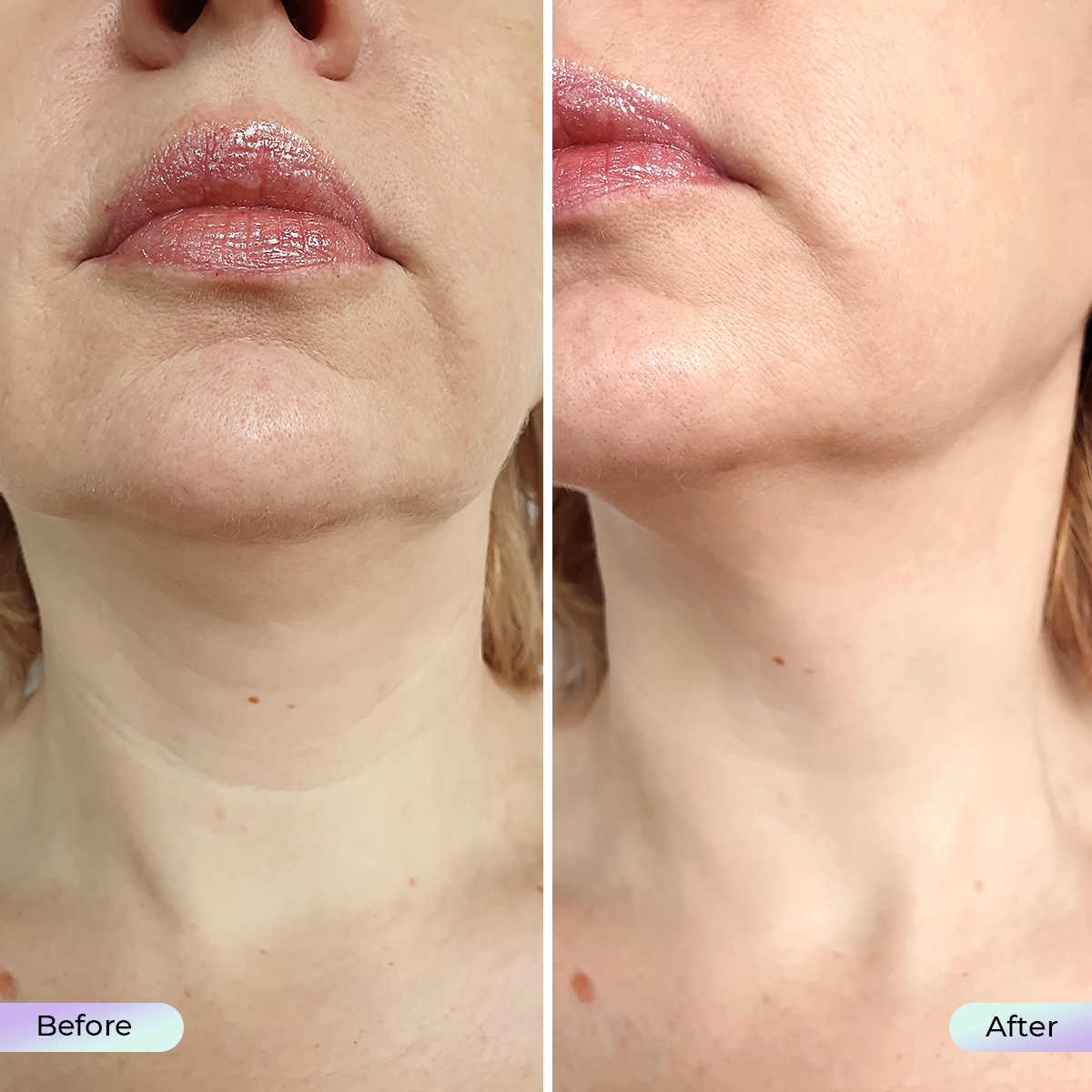 Aduro Neck and Décolleté Mask