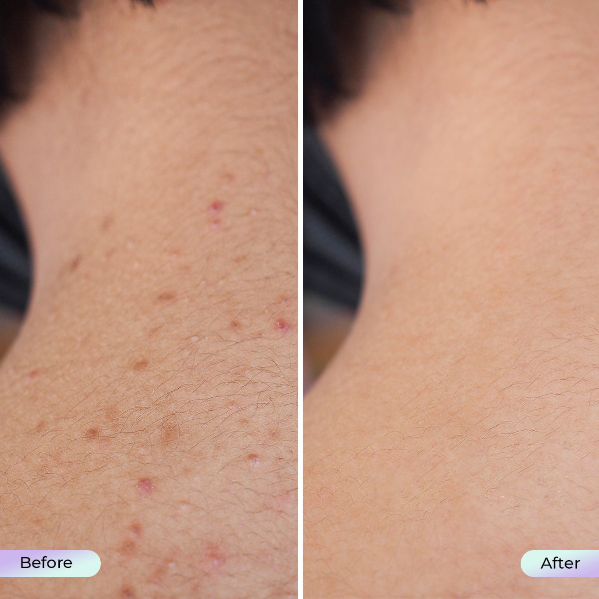 Aduro Neck and Décolleté Mask